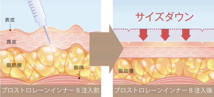 脂肪溶解×脂肪合成抑制